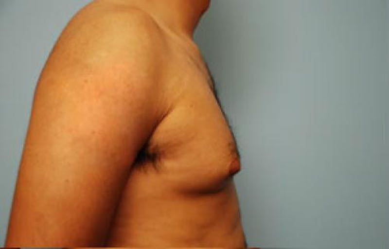 Male Procedures by Dr. Hess Before & After Gallery - Patient 134465 - Image 3