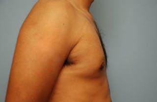 Male Breast Reduction Before & After Gallery - Patient 134465 - Image 6