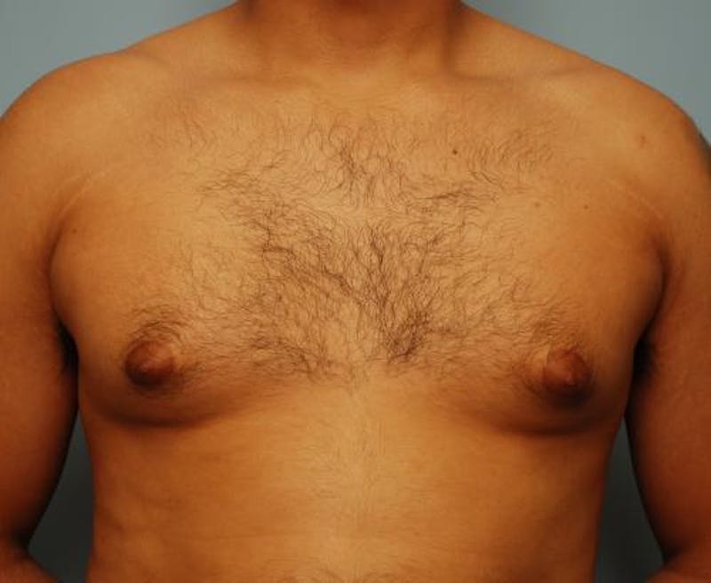 Male Procedures by Dr. Hess Before & After Gallery - Patient 134465 - Image 5
