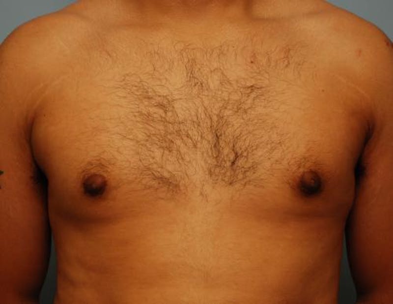 Male Procedures by Dr. Hess Before & After Gallery - Patient 134465 - Image 6