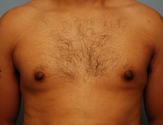 Male Breast Reduction Before & After Gallery - Patient 134465 - Image 2