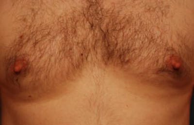 Male Procedures by Dr. Hess Before & After Gallery - Patient 320407 - Image 1