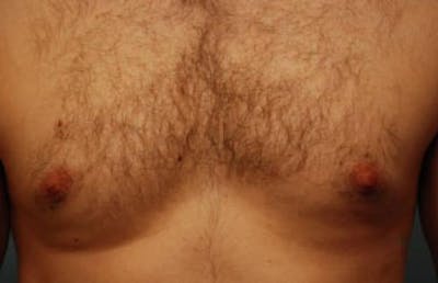 Male Procedures by Dr. Hess Before & After Gallery - Patient 320407 - Image 2