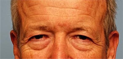 Male Procedures by Dr. Hess Before & After Gallery - Patient 324631 - Image 1