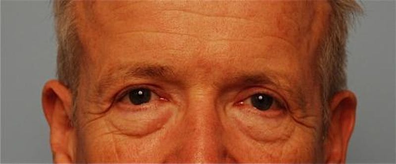 Male Procedures by Dr. Hess Before & After Gallery - Patient 324631 - Image 2