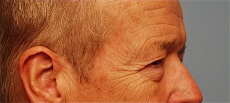 Male Procedures by Dr. Hess Before & After Gallery - Patient 324631 - Image 3