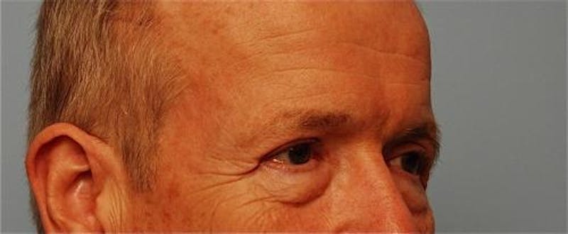 Male Procedures by Dr. Hess Before & After Gallery - Patient 324631 - Image 4