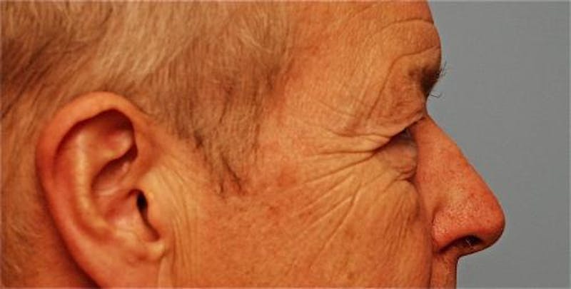 Male Procedures by Dr. Hess Before & After Gallery - Patient 324631 - Image 5