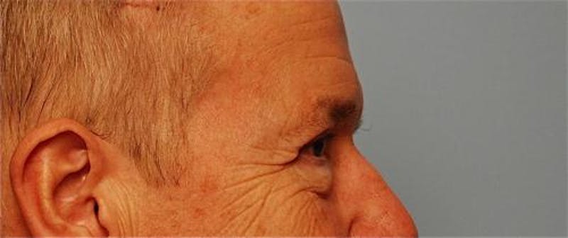 Male Procedures by Dr. Hess Before & After Gallery - Patient 324631 - Image 6