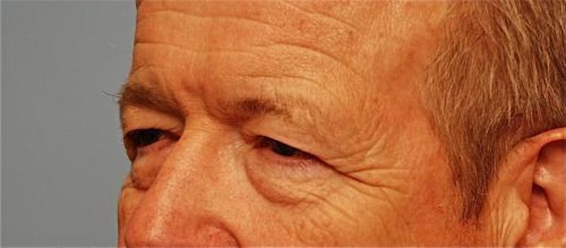 Male Procedures by Dr. Hess Before & After Gallery - Patient 324631 - Image 7
