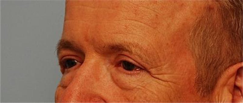 Male Procedures by Dr. Hess Before & After Gallery - Patient 324631 - Image 8