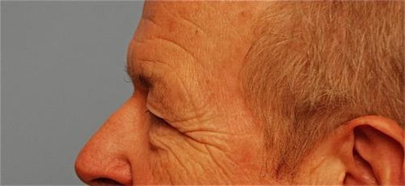 Male Procedures by Dr. Hess Before & After Gallery - Patient 324631 - Image 9