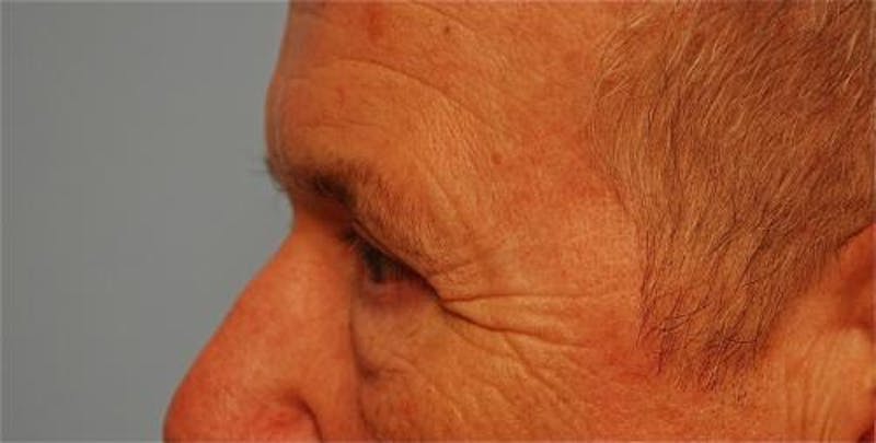 Male Procedures by Dr. Hess Before & After Gallery - Patient 324631 - Image 10