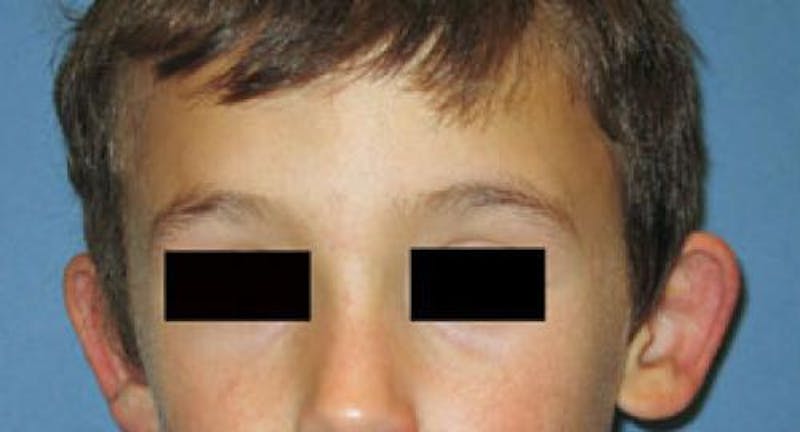 Male Procedures by Dr. Hess Before & After Gallery - Patient 286274 - Image 1