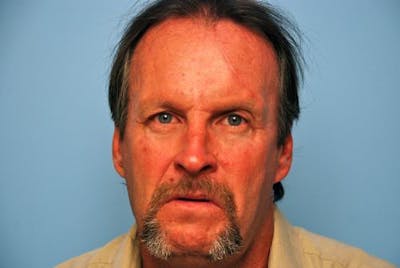 Male Procedures by Dr. Hess Before & After Gallery - Patient 520007 - Image 2