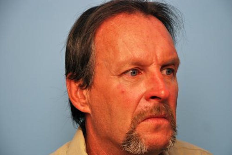 Male Procedures by Dr. Hess Before & After Gallery - Patient 520007 - Image 4