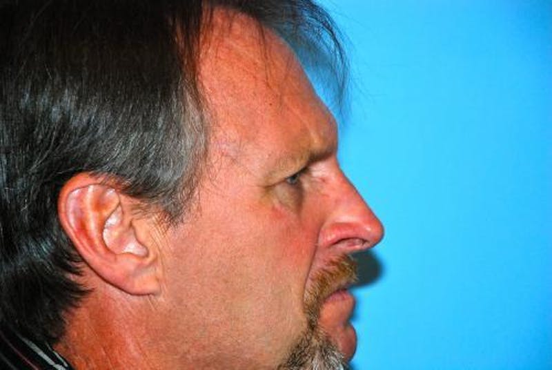 Male Procedures by Dr. Hess Before & After Gallery - Patient 520007 - Image 5