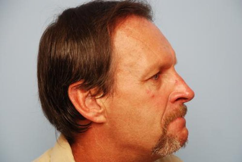 Male Procedures by Dr. Hess Before & After Gallery - Patient 520007 - Image 6