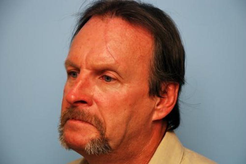 Male Procedures by Dr. Hess Before & After Gallery - Patient 520007 - Image 8