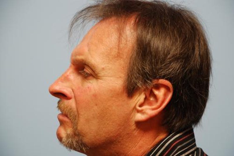 Male Procedures by Dr. Hess Before & After Gallery - Patient 520007 - Image 9