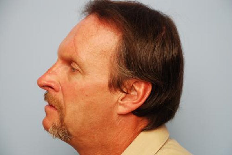 Male Procedures by Dr. Hess Before & After Gallery - Patient 520007 - Image 10
