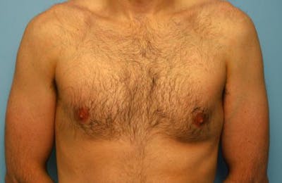 Male Procedures by Dr. Hess Before & After Gallery - Patient 392500 - Image 1