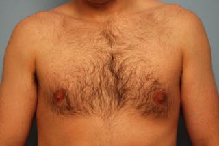 Male Breast Reduction Before & After Gallery - Patient 392500 - Image 2
