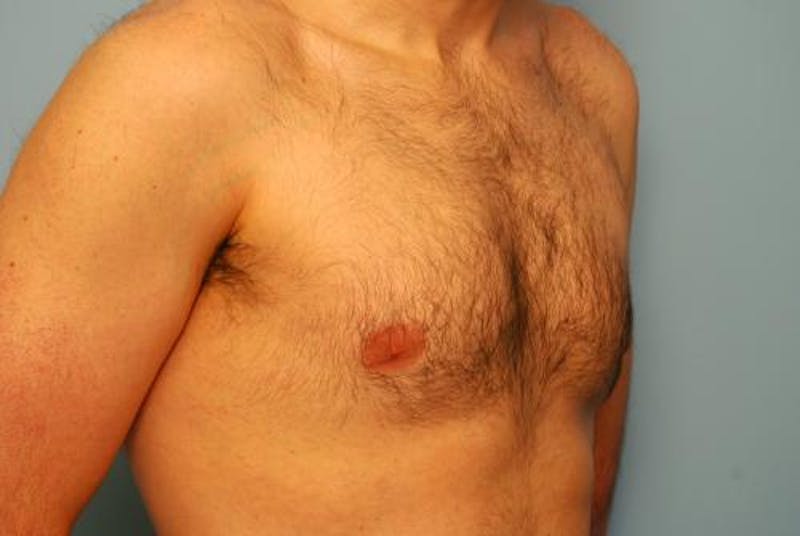 Male Procedures by Dr. Hess Before & After Gallery - Patient 392500 - Image 3
