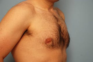 Male Breast Reduction Before & After Gallery - Patient 392500 - Image 4