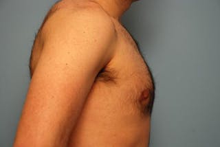 Male Breast Reduction Before & After Gallery - Patient 392500 - Image 6