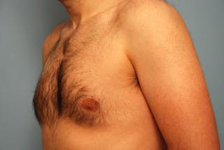 Male Breast Reduction Before & After Gallery - Patient 392500 - Image 8