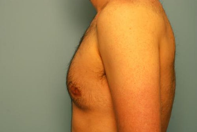 Male Procedures by Dr. Hess Before & After Gallery - Patient 392500 - Image 9