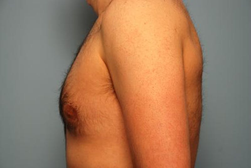Male Procedures by Dr. Hess Before & After Gallery - Patient 392500 - Image 10