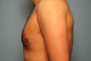 Male Breast Reduction Before & After Gallery - Patient 392500 - Image 10