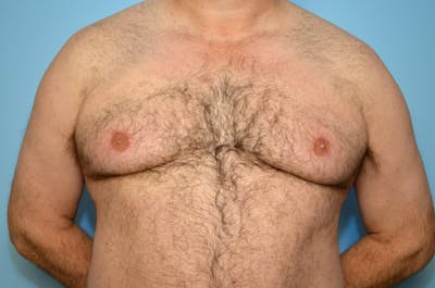 Male Procedures by Dr. Hess Before & After Gallery - Patient 332024 - Image 1
