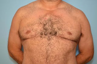 Male Breast Reduction Before & After Gallery - Patient 919901 - Image 2