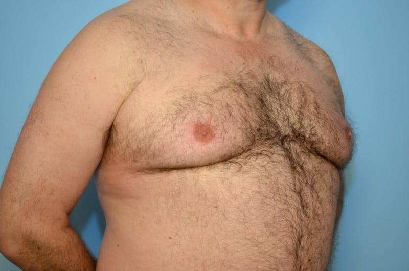 Male Procedures by Dr. Hess Before & After Gallery - Patient 919901 - Image 3