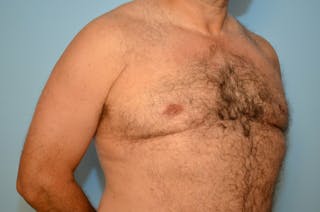 Male Breast Reduction Before & After Gallery - Patient 919901 - Image 4