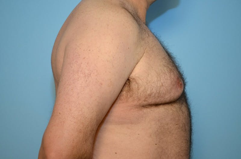 Male Procedures by Dr. Hess Before & After Gallery - Patient 919901 - Image 5