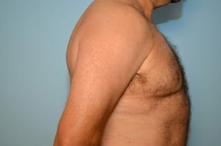 Male Breast Reduction Before & After Gallery - Patient 919901 - Image 6