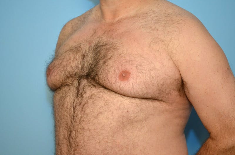 Male Procedures by Dr. Hess Before & After Gallery - Patient 919901 - Image 7