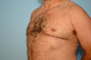 Male Breast Reduction Before & After Gallery - Patient 919901 - Image 8