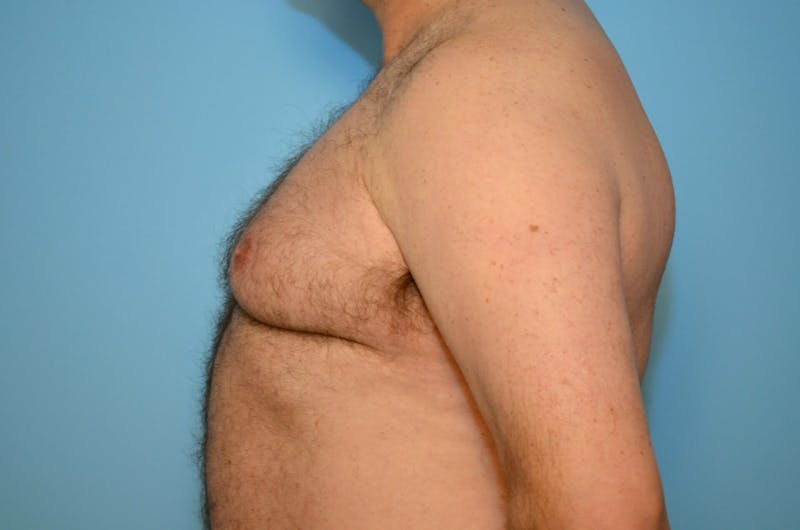 Male Procedures by Dr. Hess Before & After Gallery - Patient 919901 - Image 9