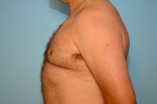 Male Breast Reduction Before & After Gallery - Patient 919901 - Image 10
