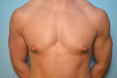 Male Procedures by Dr. Hess Before & After Gallery - Patient 273642 - Image 1
