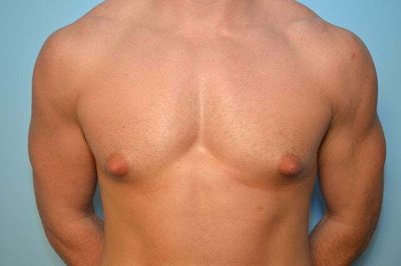 Male Procedures by Dr. Hess Before & After Gallery - Patient 273642 - Image 1