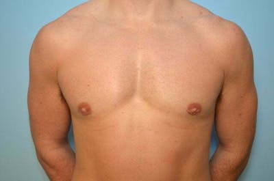Male Procedures by Dr. Hess Before & After Gallery - Patient 273642 - Image 2