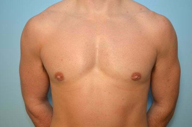 Male Procedures by Dr. Hess Before & After Gallery - Patient 273642 - Image 2