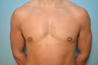 Male Breast Reduction Before & After Gallery - Patient 273642 - Image 2