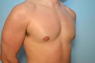 Male Breast Reduction Before & After Gallery - Patient 273642 - Image 4